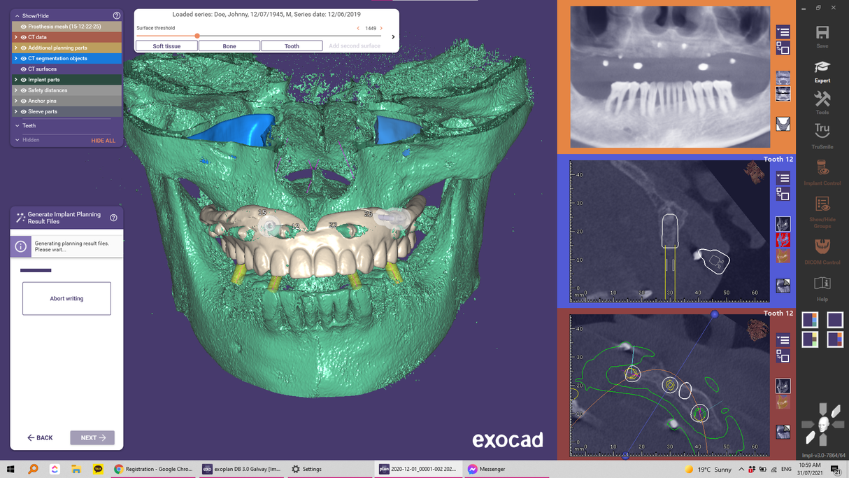 Exoplan (Surgical Guide by Exocad)