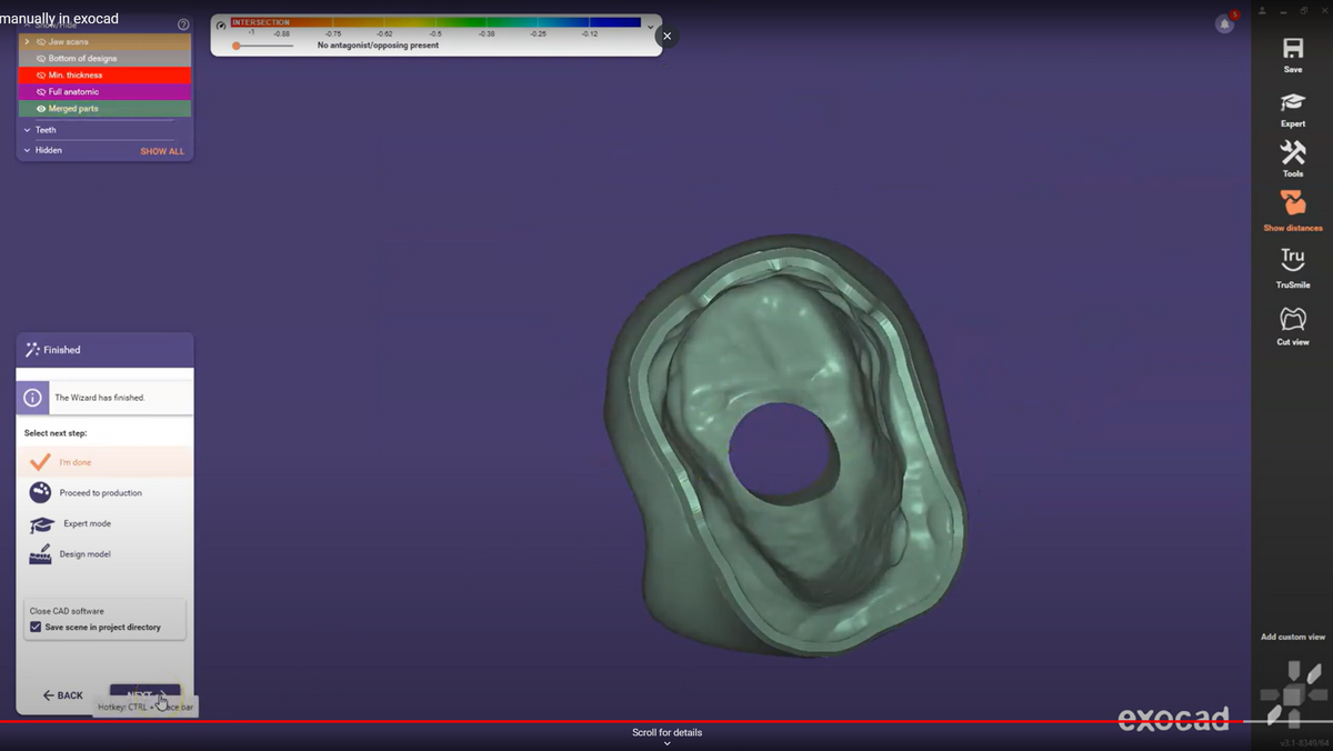 Exocad Temp Shells Essential Tips for Exocad – CM MEDICAL - Digital Dentistry Solution ...