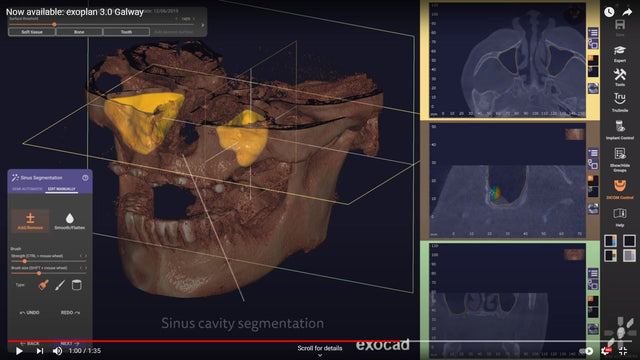 In Office Surgical Guide Solution
