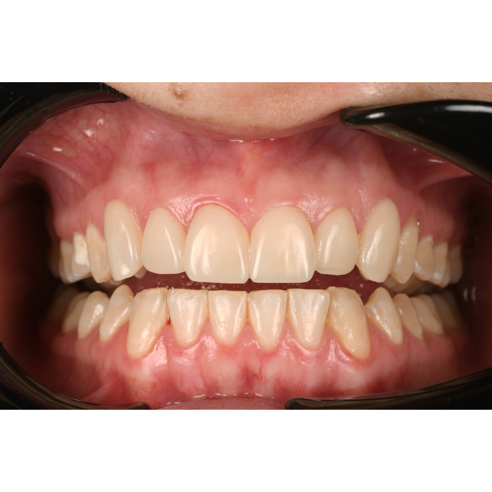 HASS Amber® Mill Direct - Crystalized Nano Lithium with Gradient