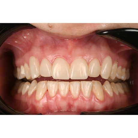 HASS Amber® Mill Direct - Crystalized Nano Lithium with Gradient