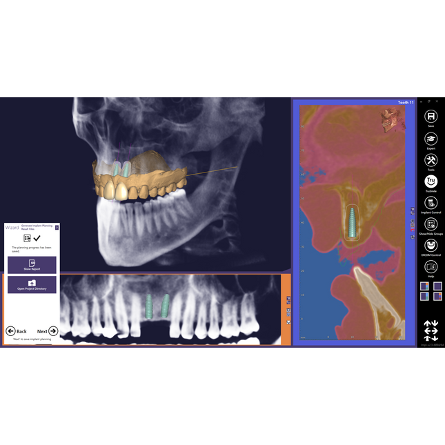 Exoplan (Surgical Guide by Exocad)