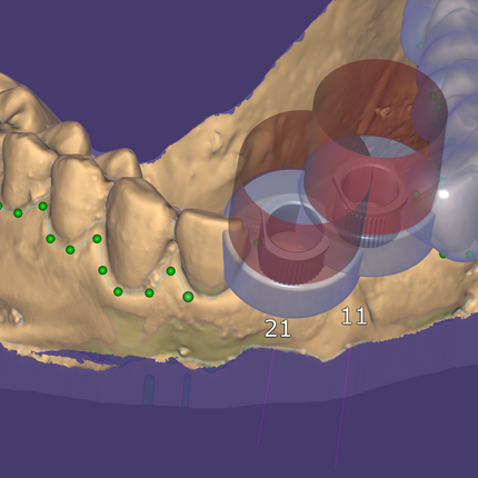 Exoplan (Surgical Guide by Exocad)