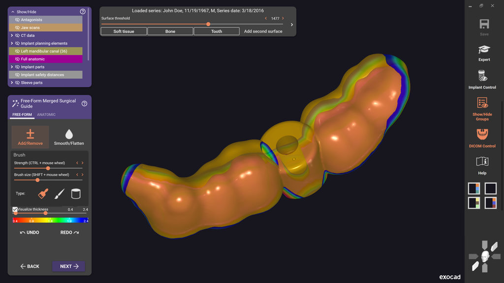 Exoplan (Surgical Guide by Exocad) – CM MEDICAL - Digital Dentistry ...