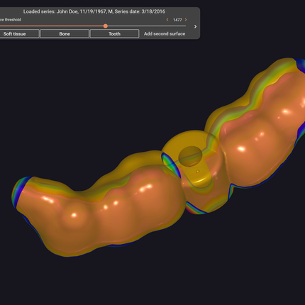 Exoplan (Surgical Guide by Exocad)