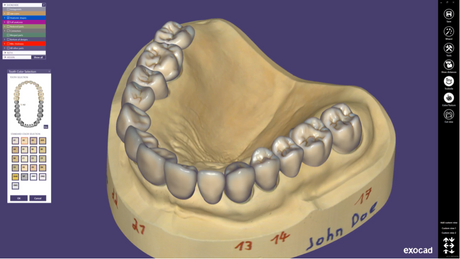 Exocad DentalCAD (for Dental Professionals)