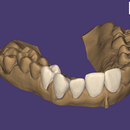 Exocad DentalCAD (for Dental Professionals)