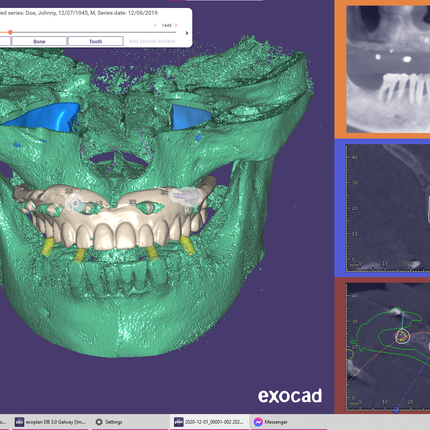 Exoplan (Surgical Guide by Exocad)