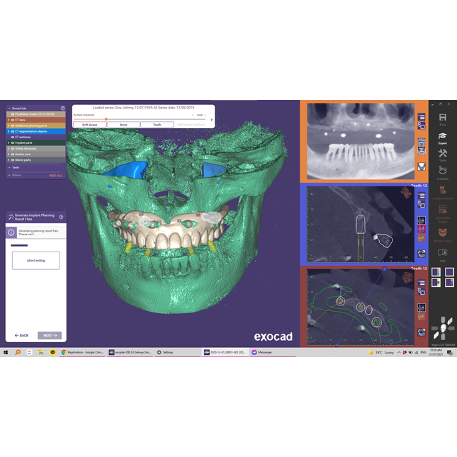 Exoplan (Surgical Guide by Exocad)
