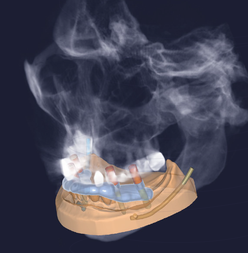 Exoplan (Surgical Guide by Exocad)