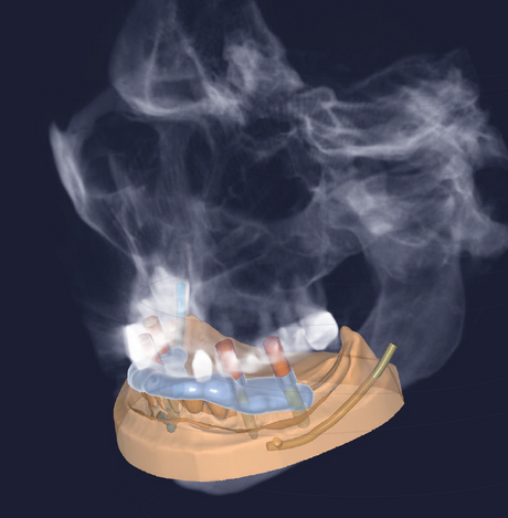 Exoplan (Surgical Guide by Exocad)